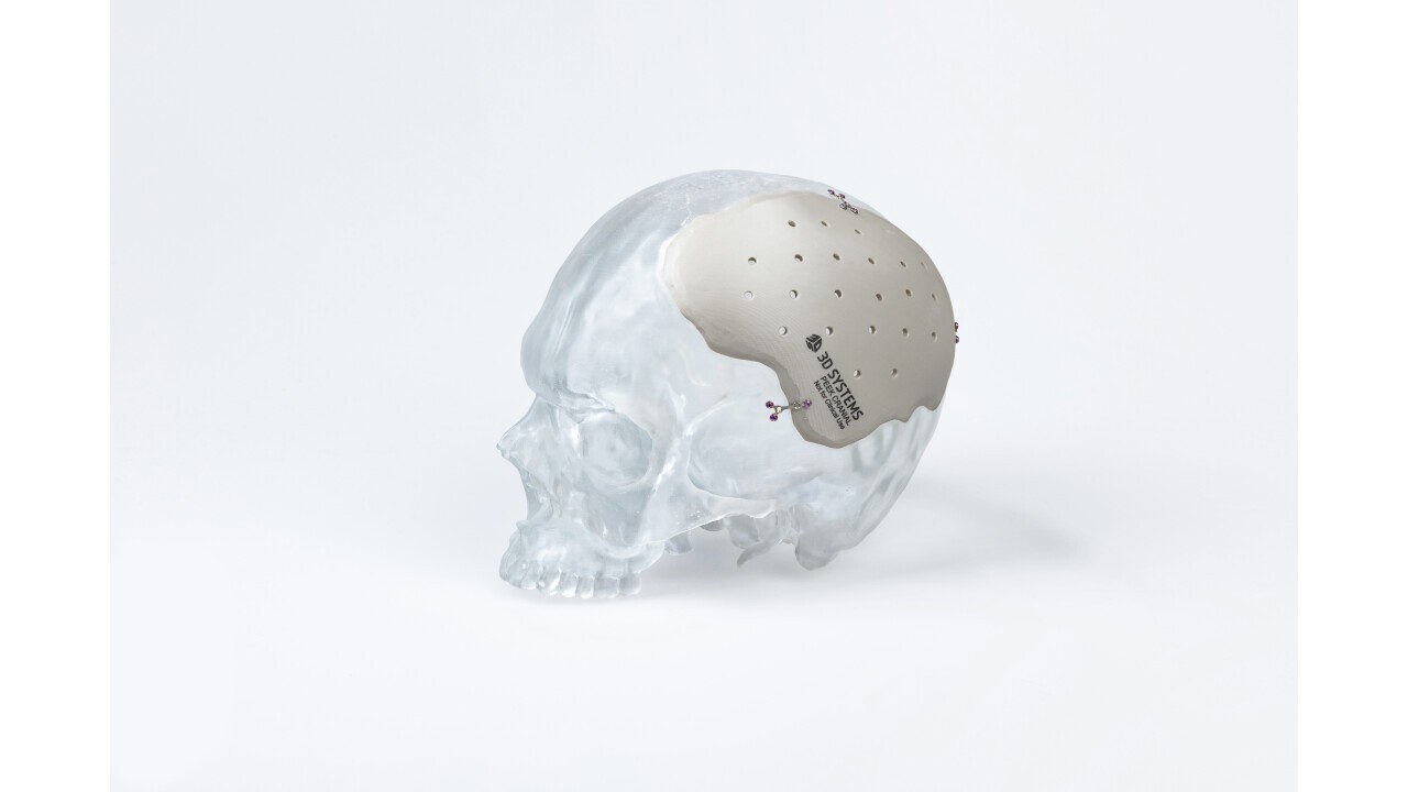 3D-printed patient specific PEEK Cranial Implant ; Copyright by 3D Systems