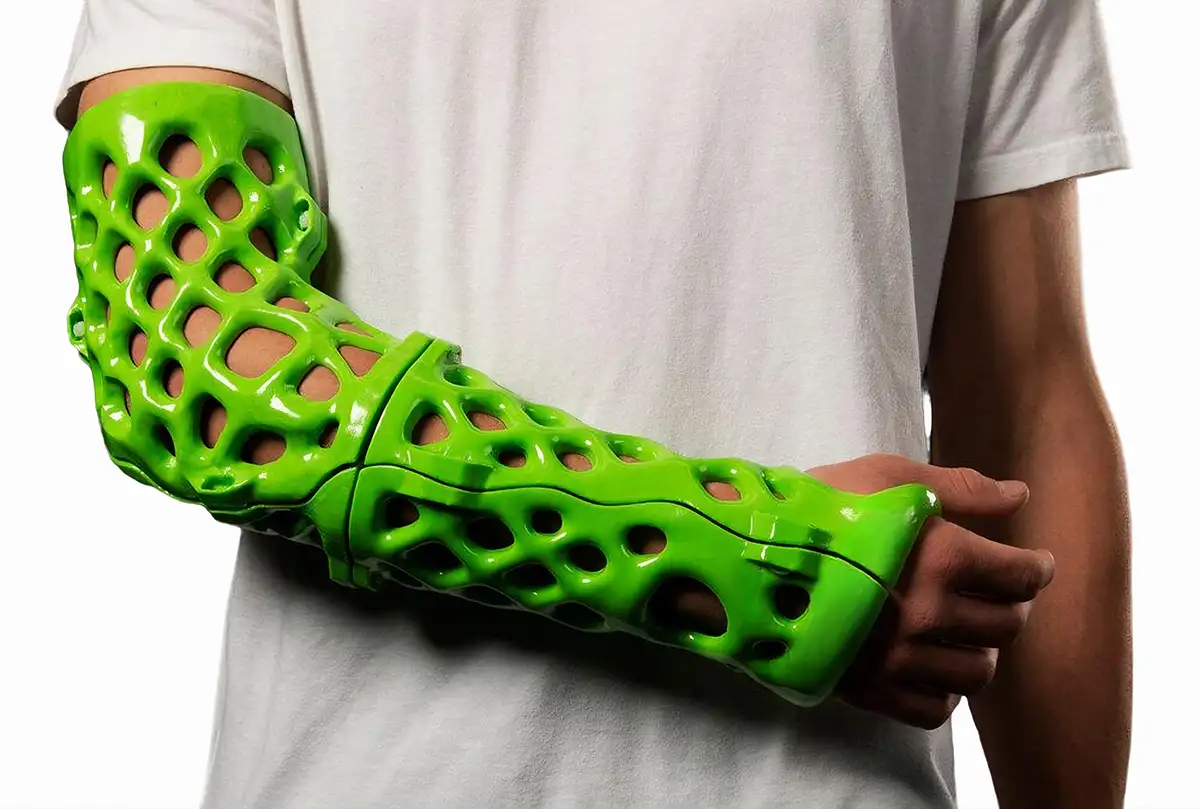 3D printing of a splint for the broken arm. 